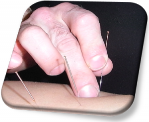 acupuncture